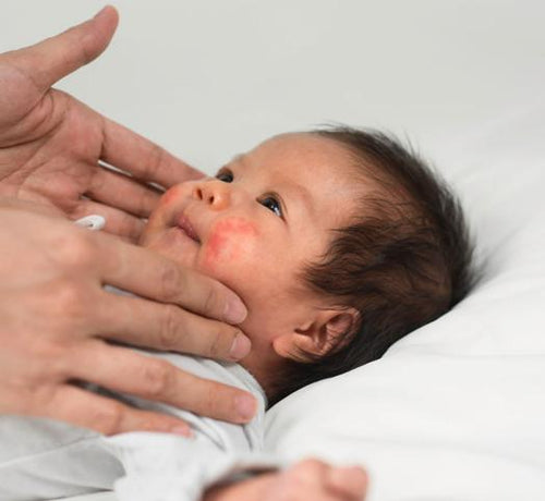 Dermatitis atópica en bebés y niños: causas, síntomas y cuidados - Mustela Mexico - 1
