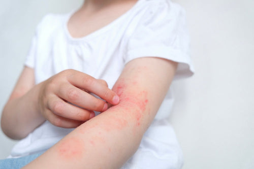 Cómo prevenir los brotes de dermatitis atópica en bebés: guía de cuidados - Mustela Mexico - 1
