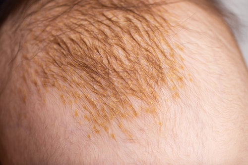 Costra láctea en bebés: causas, cuidados y cómo tratarla correctamente - Mustela Mexico - 1